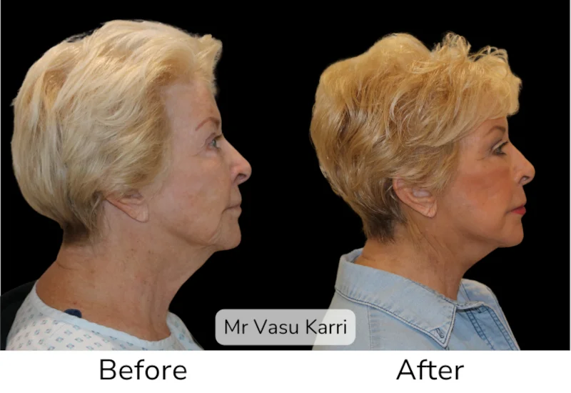 Facelift Patient 5 View 2